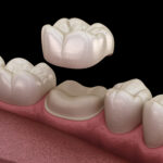 Dental Crowns & Bridges, Dazzling smiles Lara, Dentist in Lara