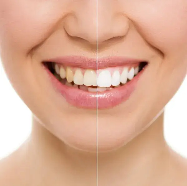 denist in lara, side effects of Teeth Whitening